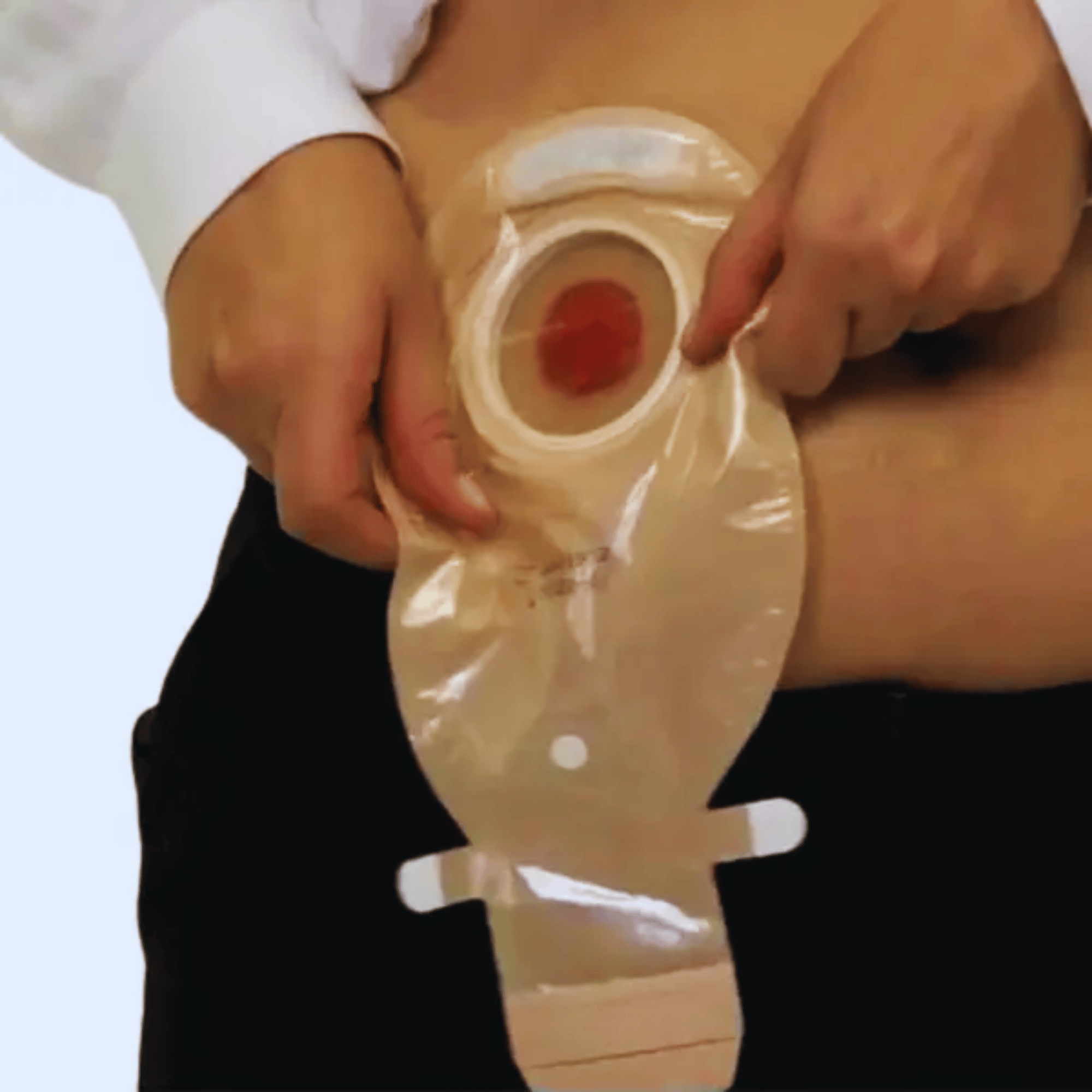  Estomia (Bolsa de Colostomia/Ileostomia) 